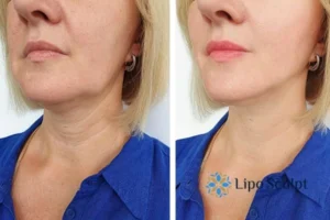 Double chin before and after Hi-Fu treatment 4 Book your double chin treatment Altrincham today! We are here to help!
