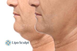 Double chin before and after Hi-Fu treatment 2 Double chin treatment Altrincham from Lipo Sculpt - feel more confident today!