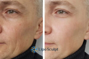 How to Fight Aging Symptoms 3 Fight Aging Symptoms Altrincham With HIFU and Morpheus8 Today!