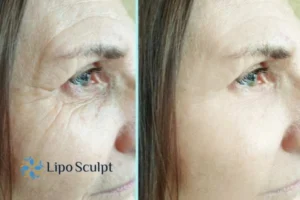 How to Fight Aging Symptoms 2 Do you want to Fight Aging Symptoms Altrincham? Contact Lipo Sculpt today!