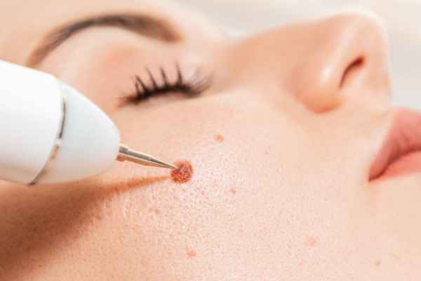 CryoPen: 5 Skin Concerns It May Be Used to Treat 3 What actually happens during a CryoPen treatment Altrincham?