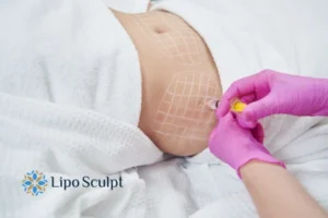 Are The Results From Aqualyx Permanent? 1 Do you want to know how long Aqualyx Altrincham results last?