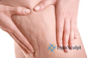 CoolSculpting for Legs: The Innovative Approach to Redefining Your Legs 5 Start your journey today book your coolsculpting treatment Altrincham online today!