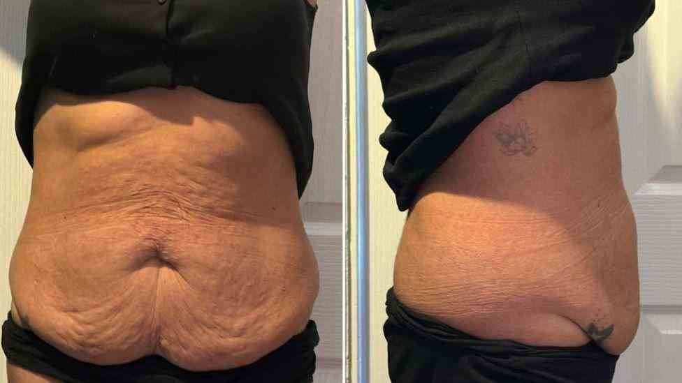 Lost the Weight but Not the Loose Skin? What You Should Know 1 Is It Definitely Loose Skin Altrincham?